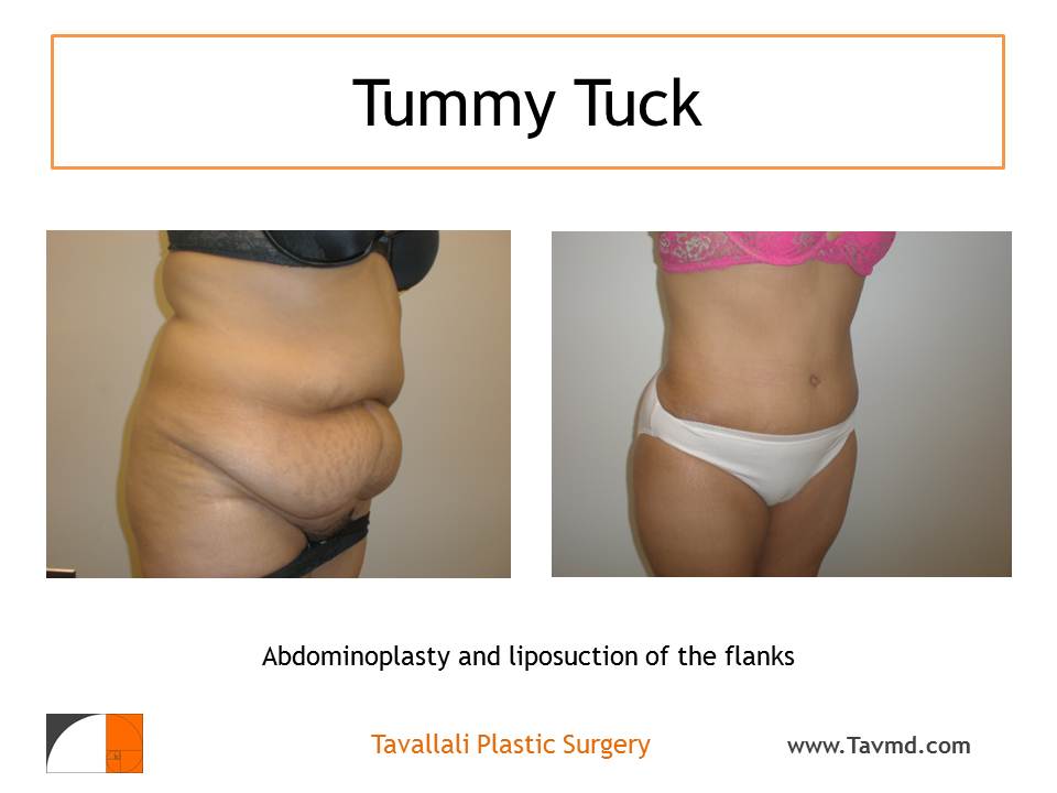 Abdominoplasty Without Drains