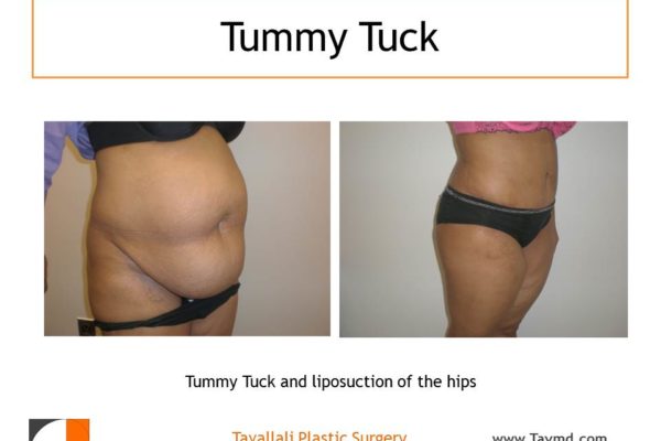 Full Tummy tuck abdominoplasty before after with muscle tightening
